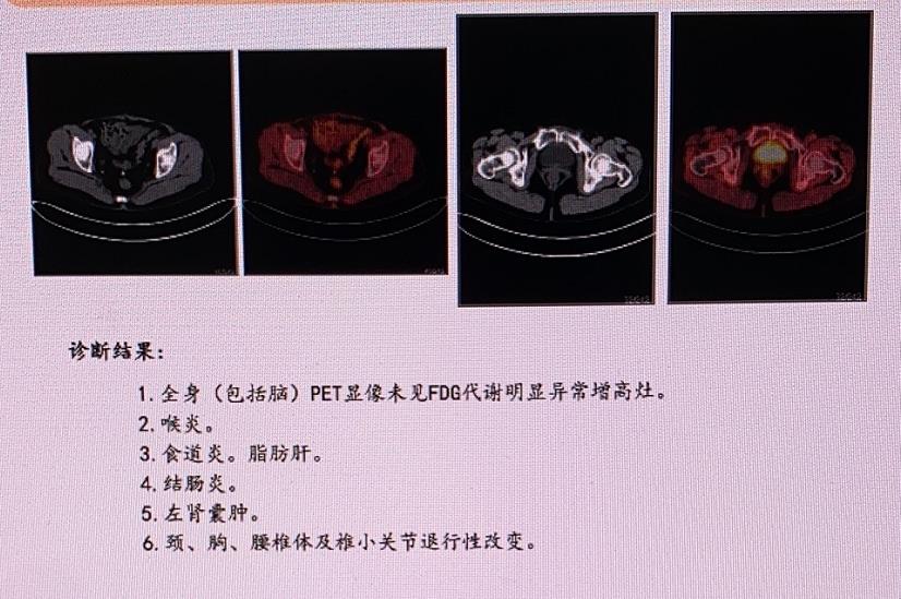 健康体检做PETCT检查